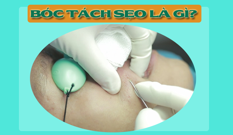 boc-tach-seo-la-gi-0