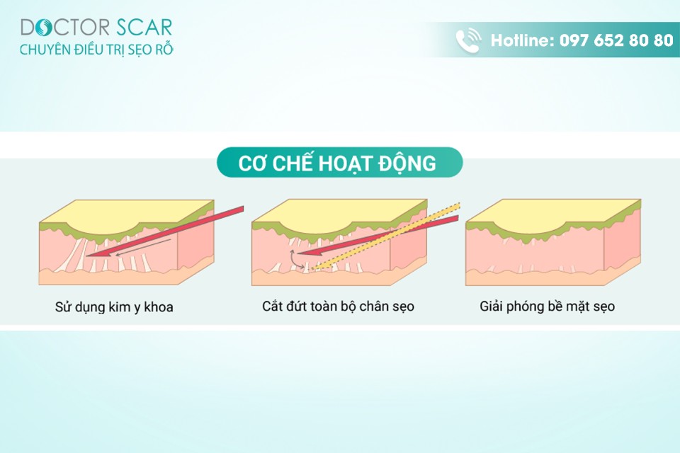 cách chăm sóc da sau cắt đáy sẹo rỗ