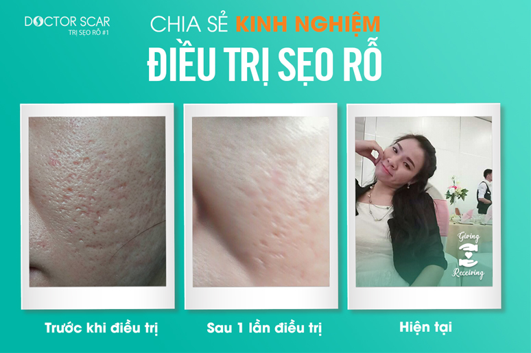 chia-se-kinh-nghiem-dieu-tri-seo-ro-Luong-Thi-Hong