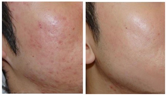 cong-nghe-laser-fractional-co2-ket-hop-prp