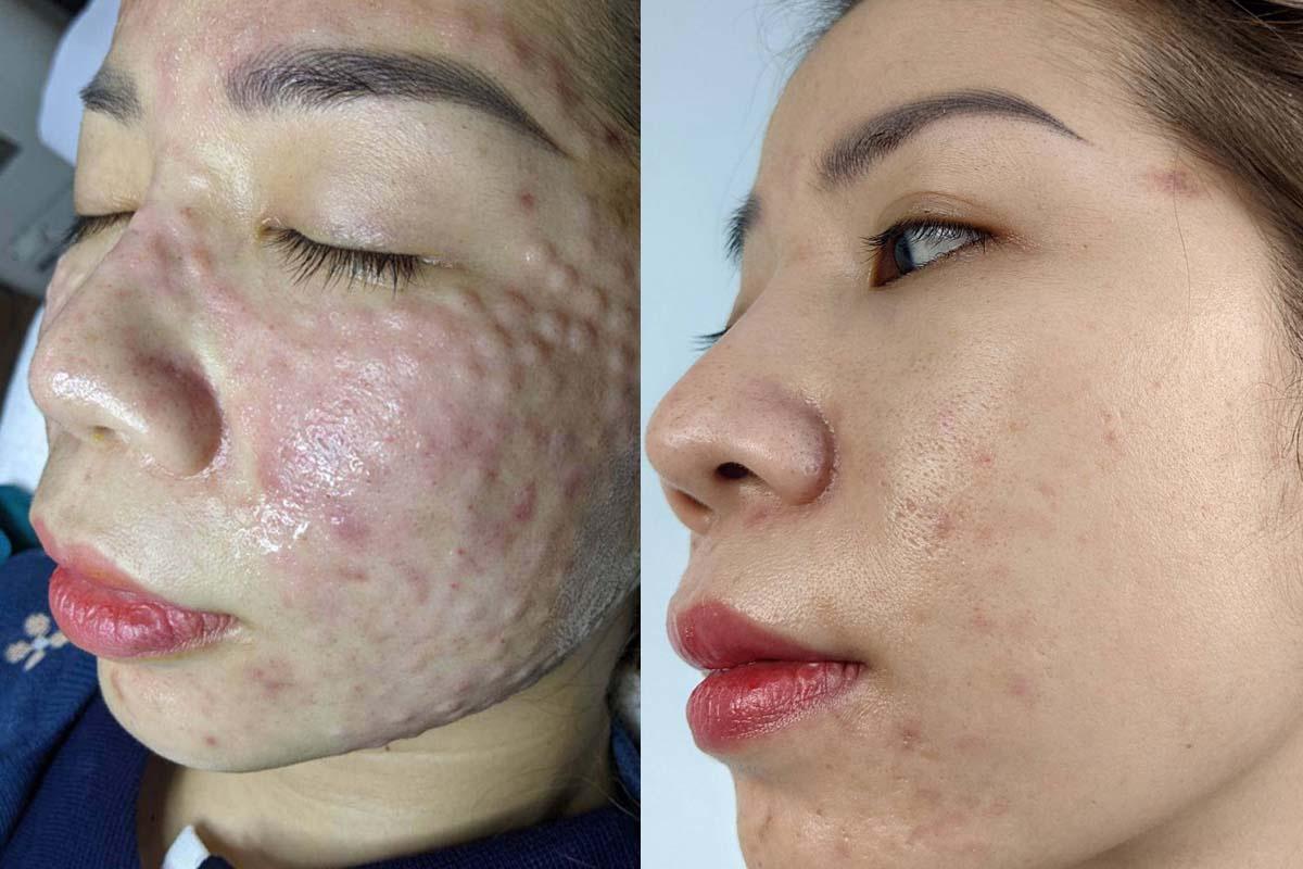 Hình ảnh khách hàng 1: da mặt sau khi tiêm meso, sẹo rỗ được cải thiện đáng kể, da trở nên mịn màng và sáng khỏe