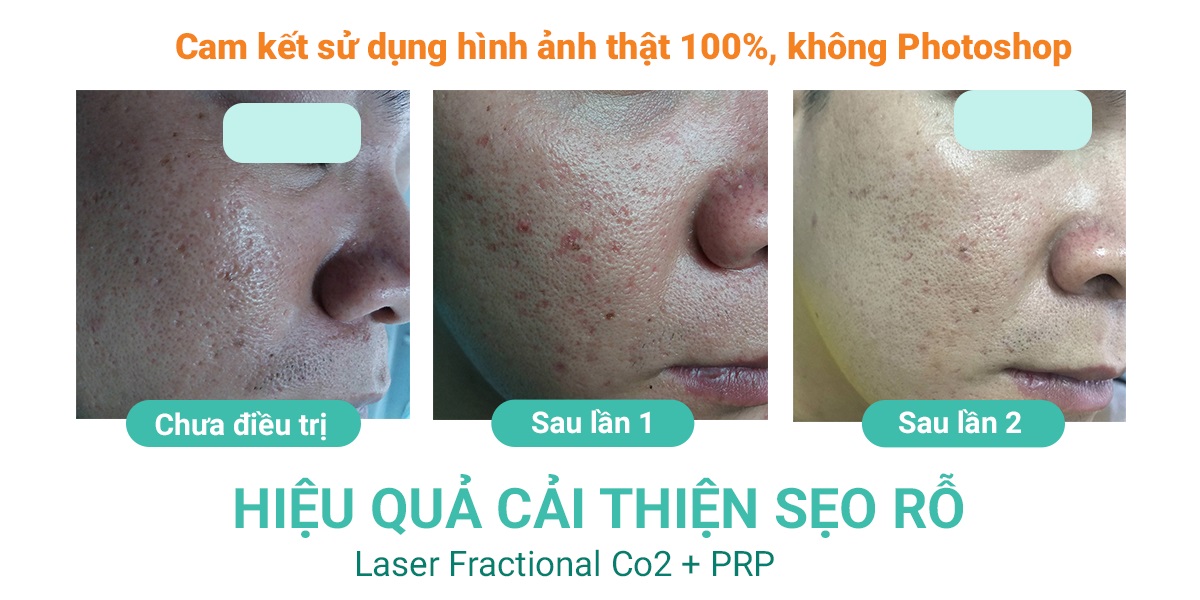 laser-fractional-co2-ket-hop-prp