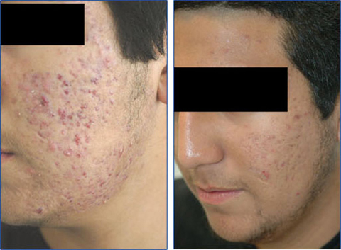 tri-seo-bang-laser-fractional-co2