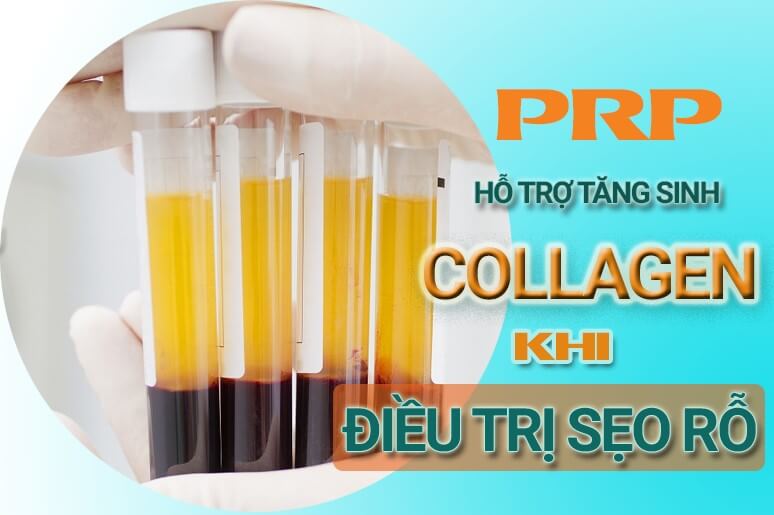 tăng sinh collagen trị sẹo rỗ bằng prp