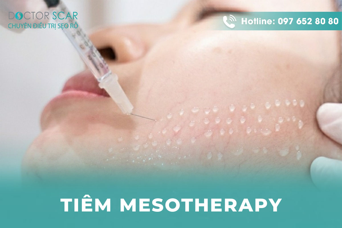 Phương pháp tiêm mesotherapy là gì?
