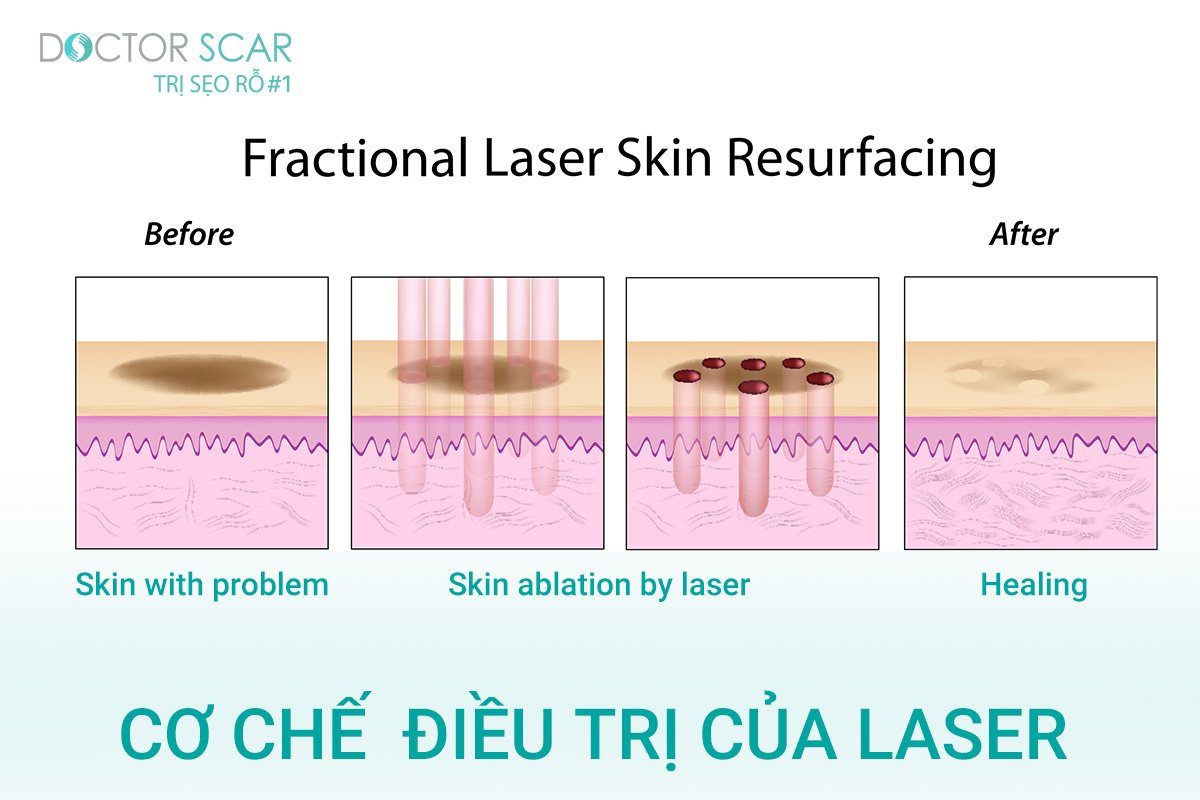 Cơ chế hoạt động của laser co2 trong điều trị sẹo tai nạn