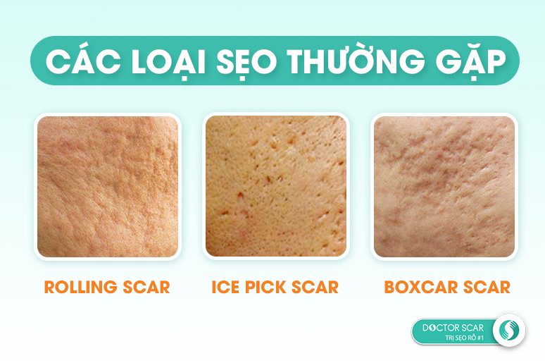01-phan-loai-seo-ro-seo-lom-va-phuong-phap-dieu-tri-hieu-qua