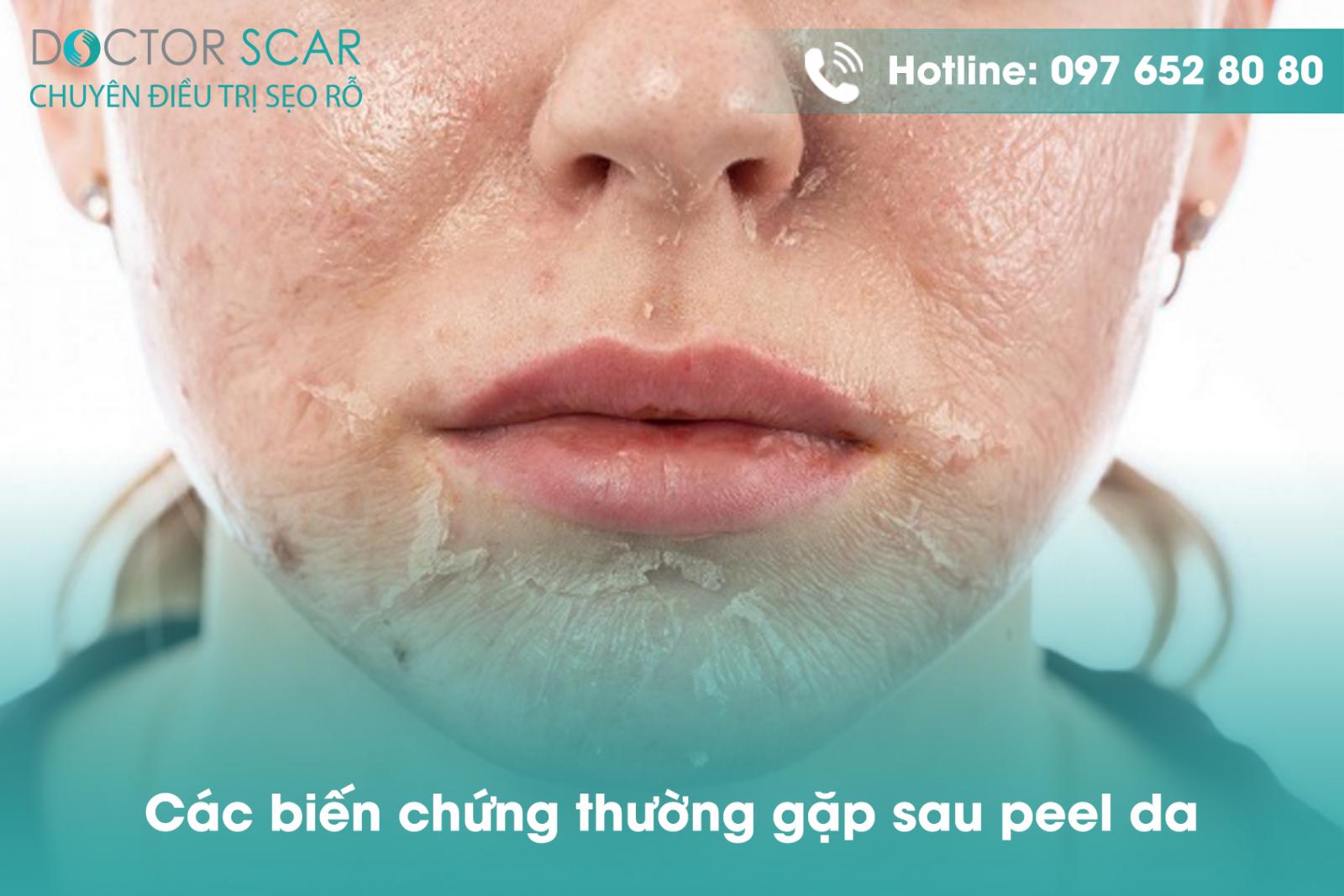 Các biến chứng thường gặp sau peel da