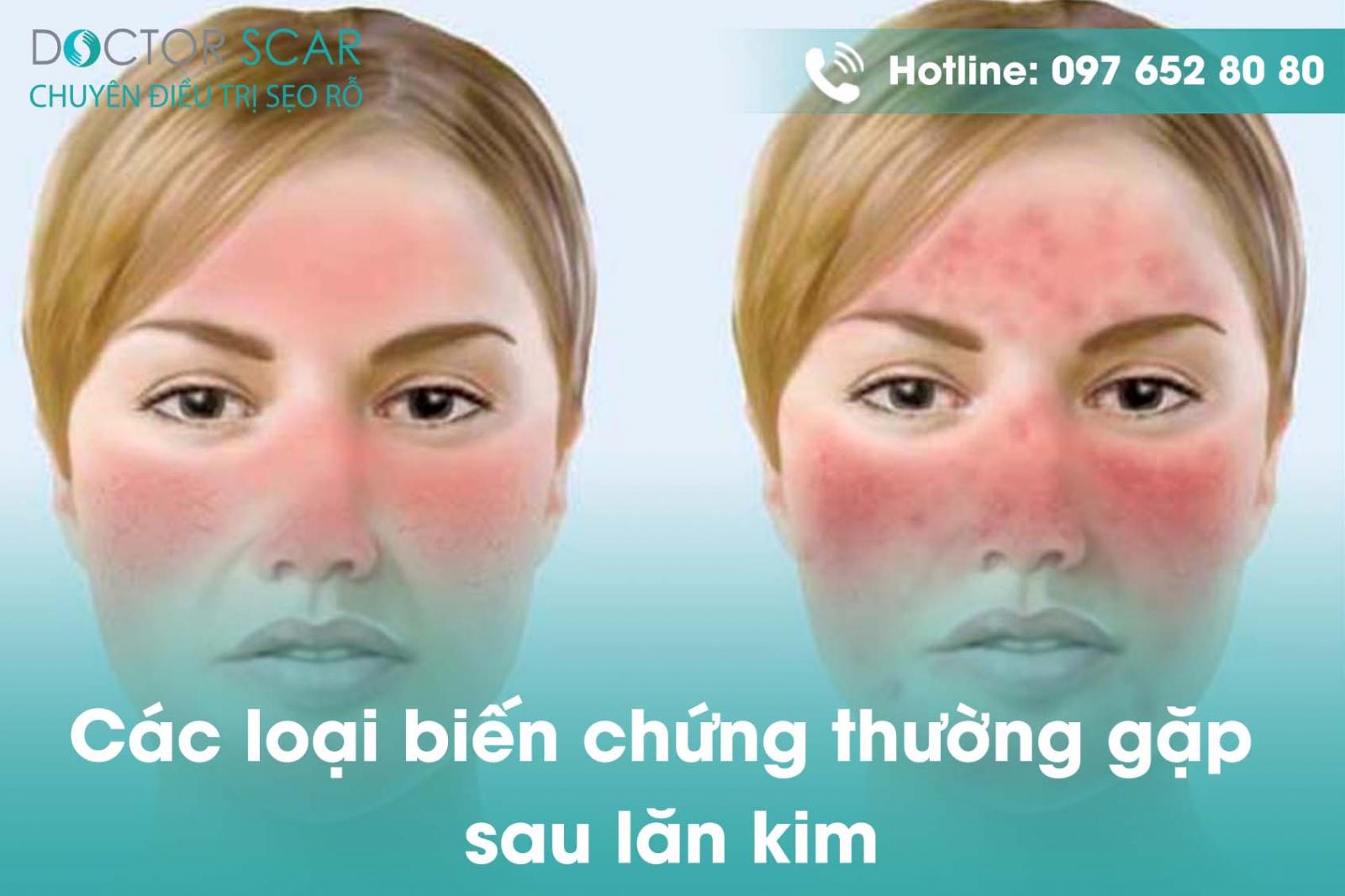 Các loại biến chứng thường gặp sau lăn kim.