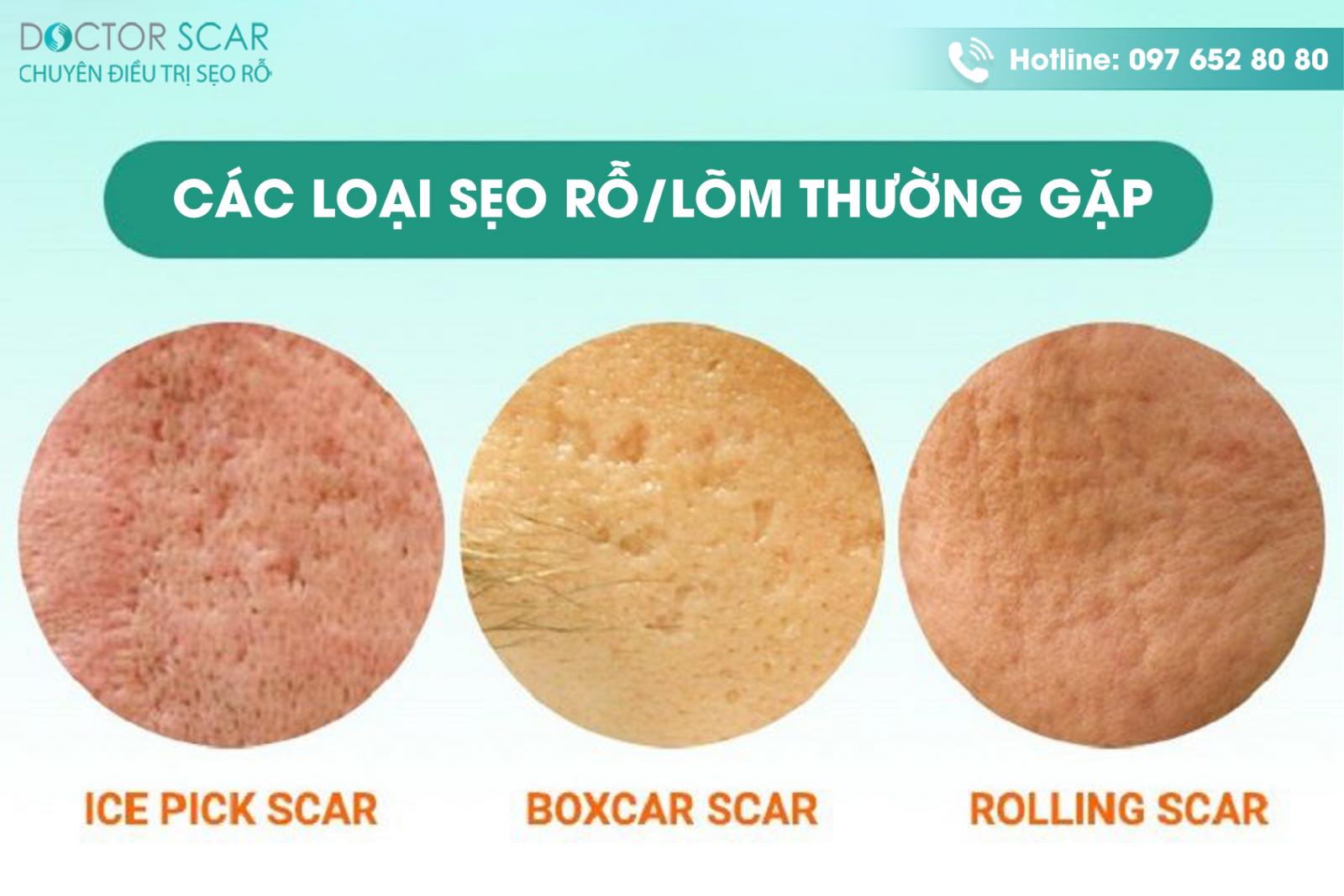 Các loại sẹo rỗ/lõm thường gặp