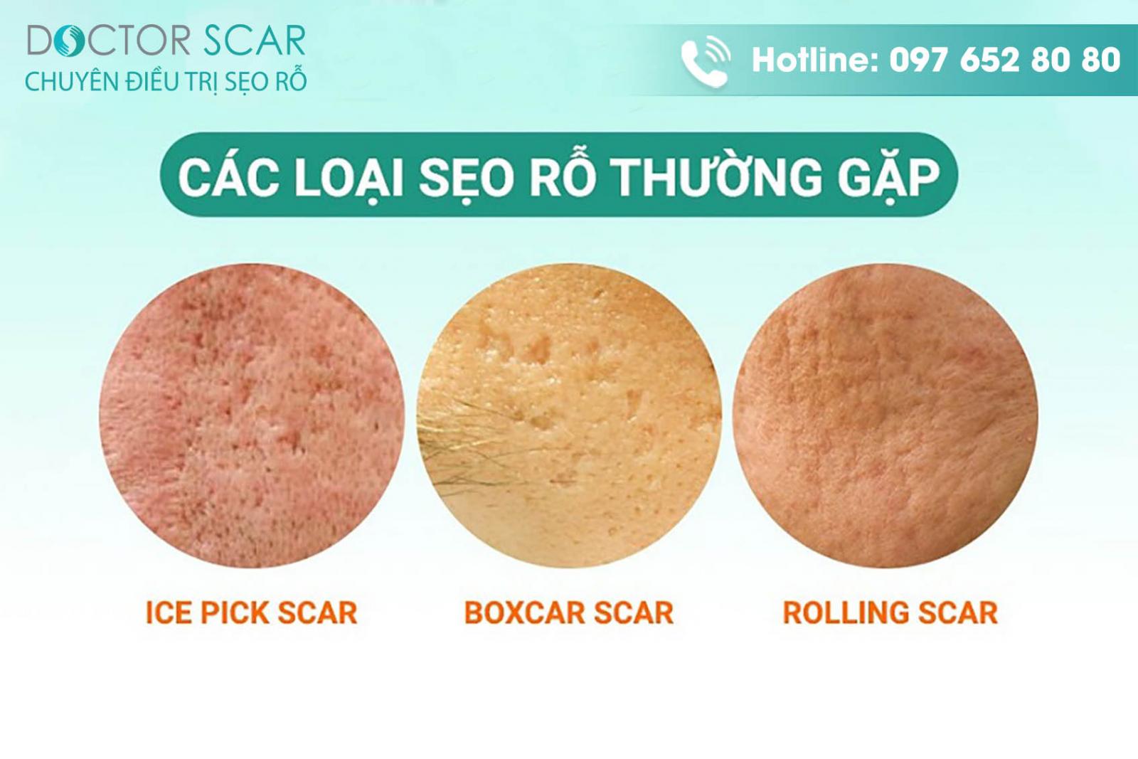 Các loại sẹo rỗ nặng thường gặp hiện nay