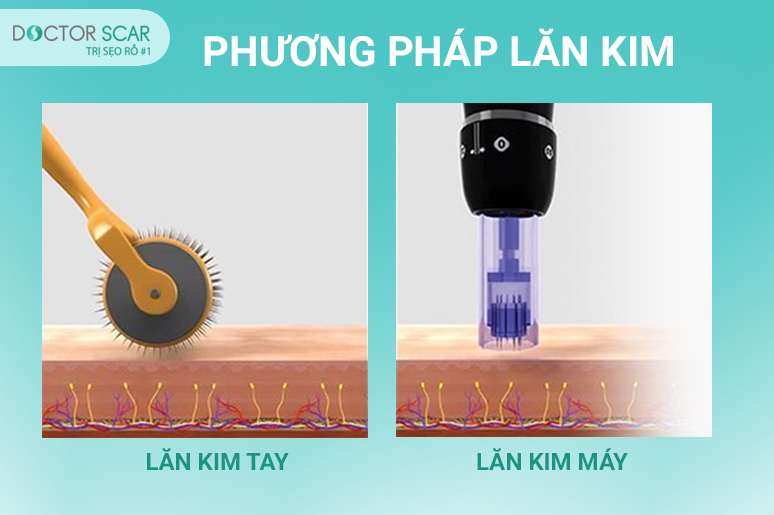 Cach-dieu-tri-seo-tham-hieu-qua-3