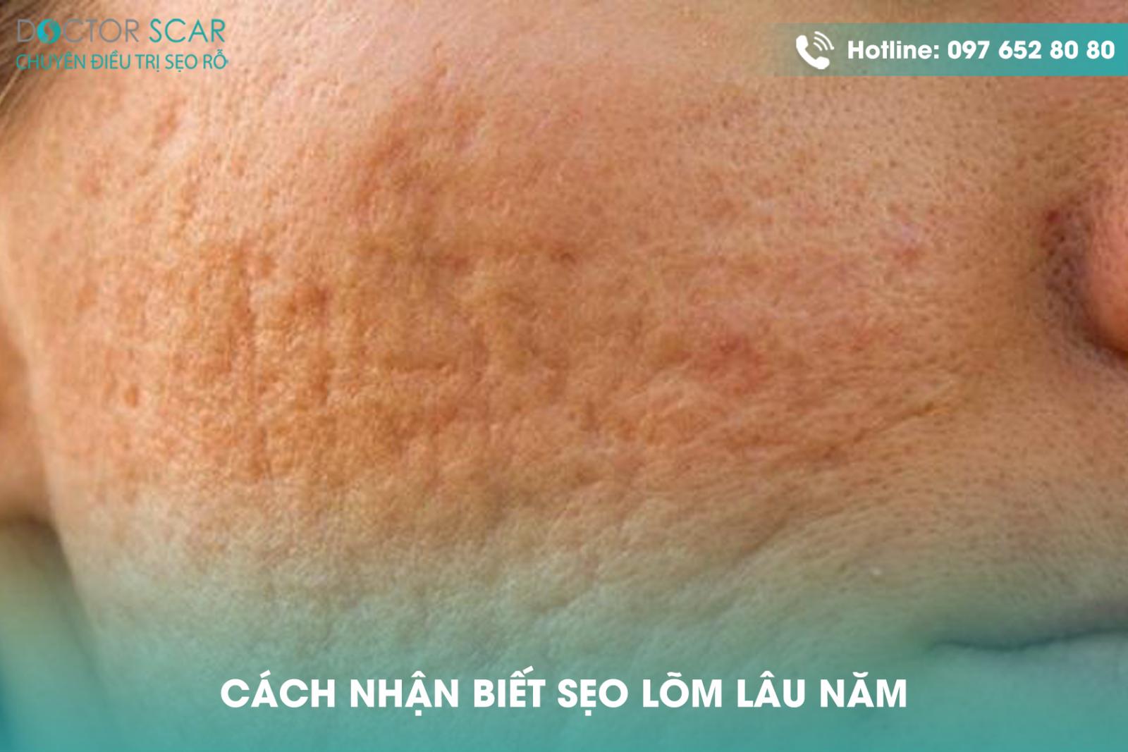 Cách nhận biết sẹo lõm lâu năm