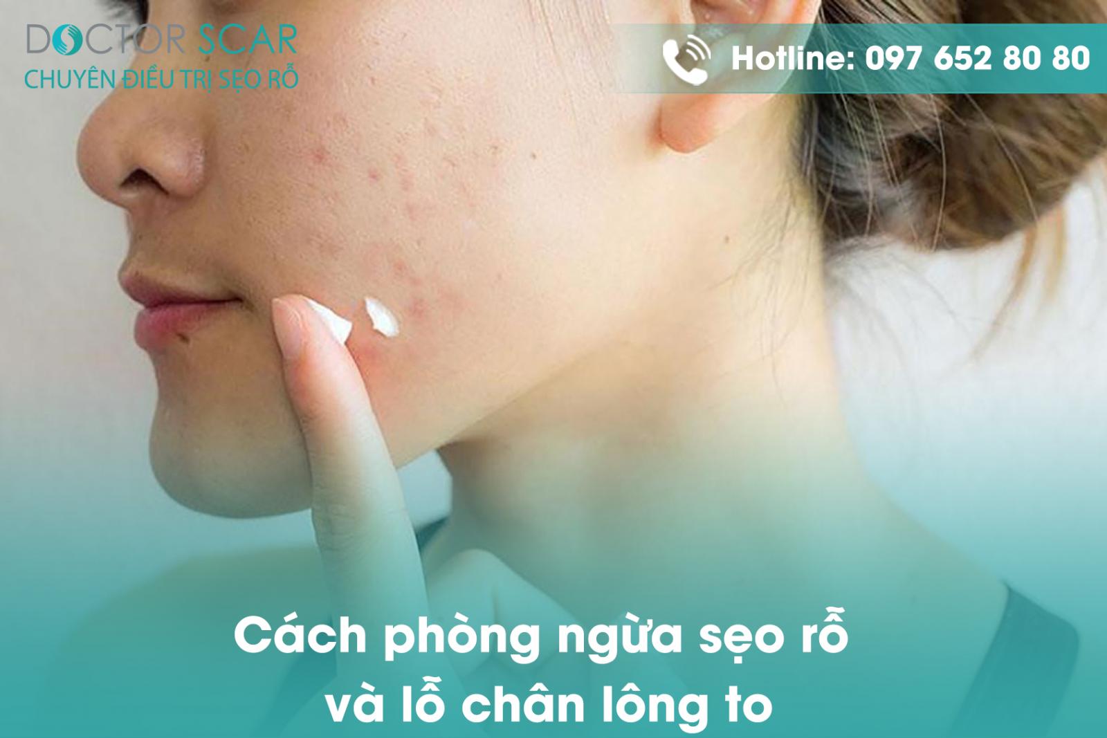 Cách phòng ngừa sẹo rỗ và lỗ chân lông to