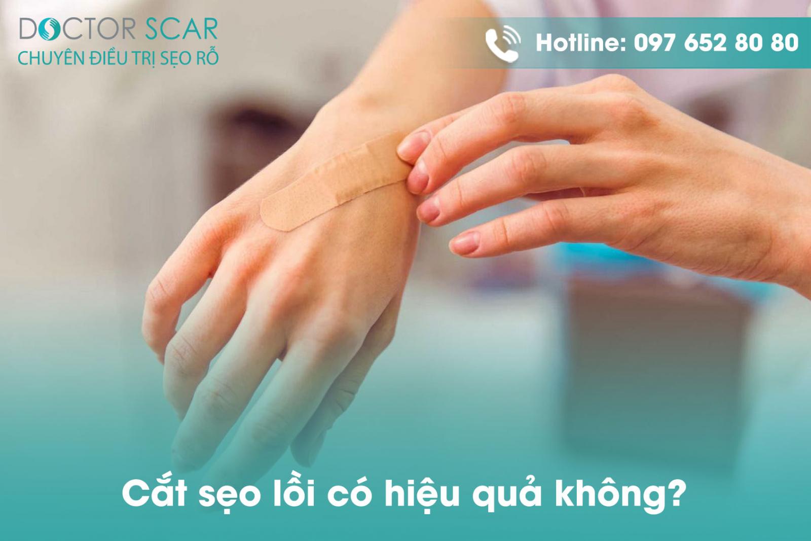 Cắt sẹo lồi có hiệu quả không?