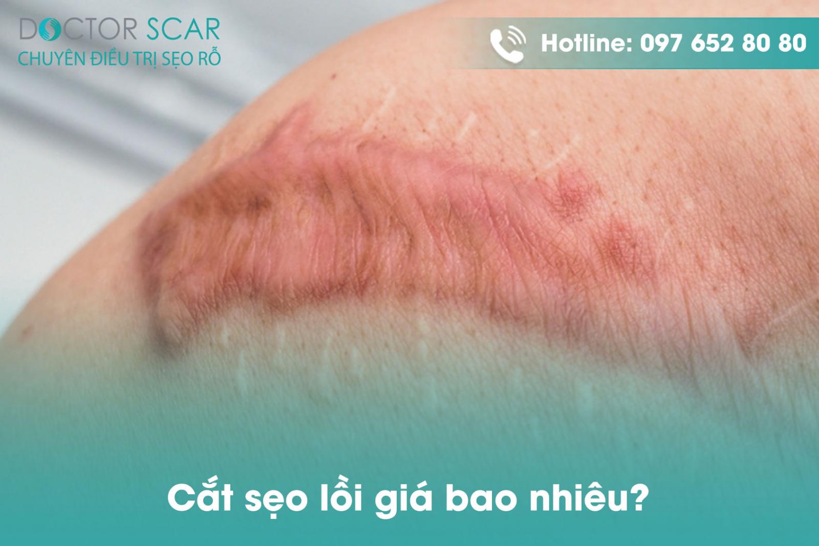 Cắt sẹo lồi giá bao nhiêu?