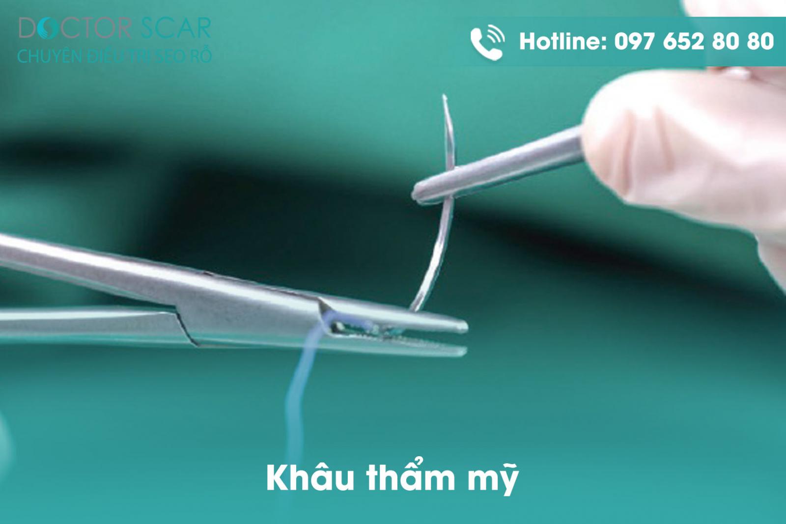 Cắt sẹo lồi và khâu thẩm mỹ