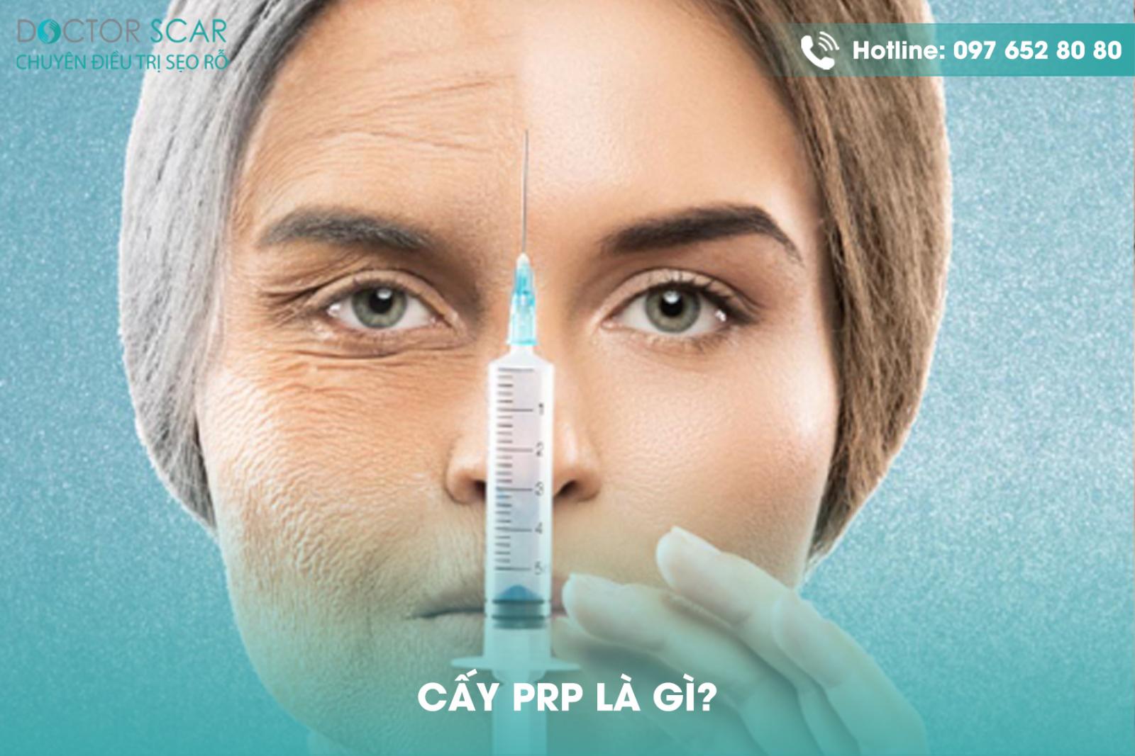 Cấy PRP là gì?