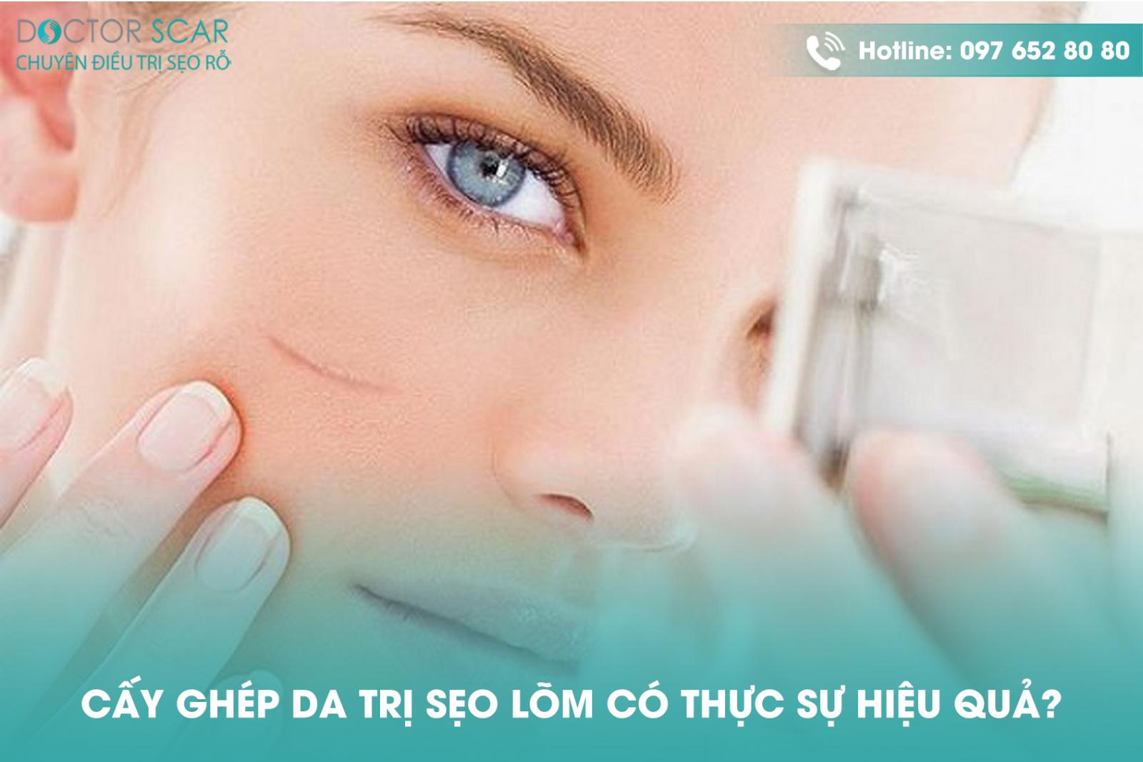 Cấy ghép da trị sẹo lõm có thực sự hiệu quả?