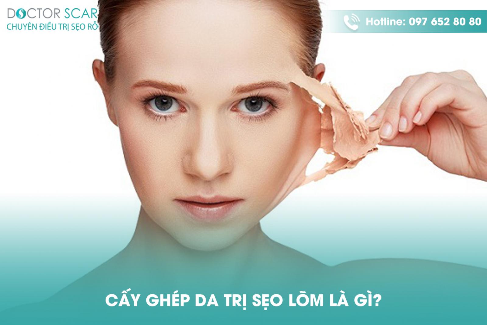 Cấy ghép da trị sẹo lõm là gì?