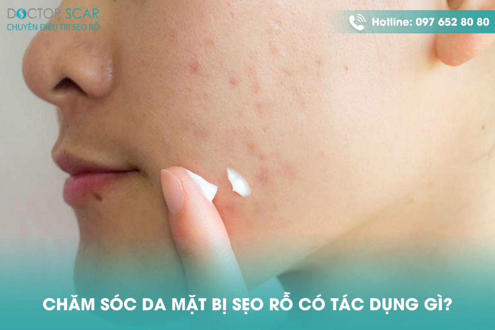 Chăm sóc da mặt bị sẹo rỗ có tác dụng gì?
