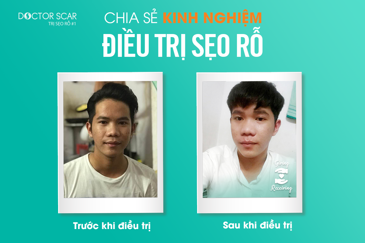 Chia-se-kinh-nghiem-dieu-tri-seo-ro -Le-Quoc-Cuong