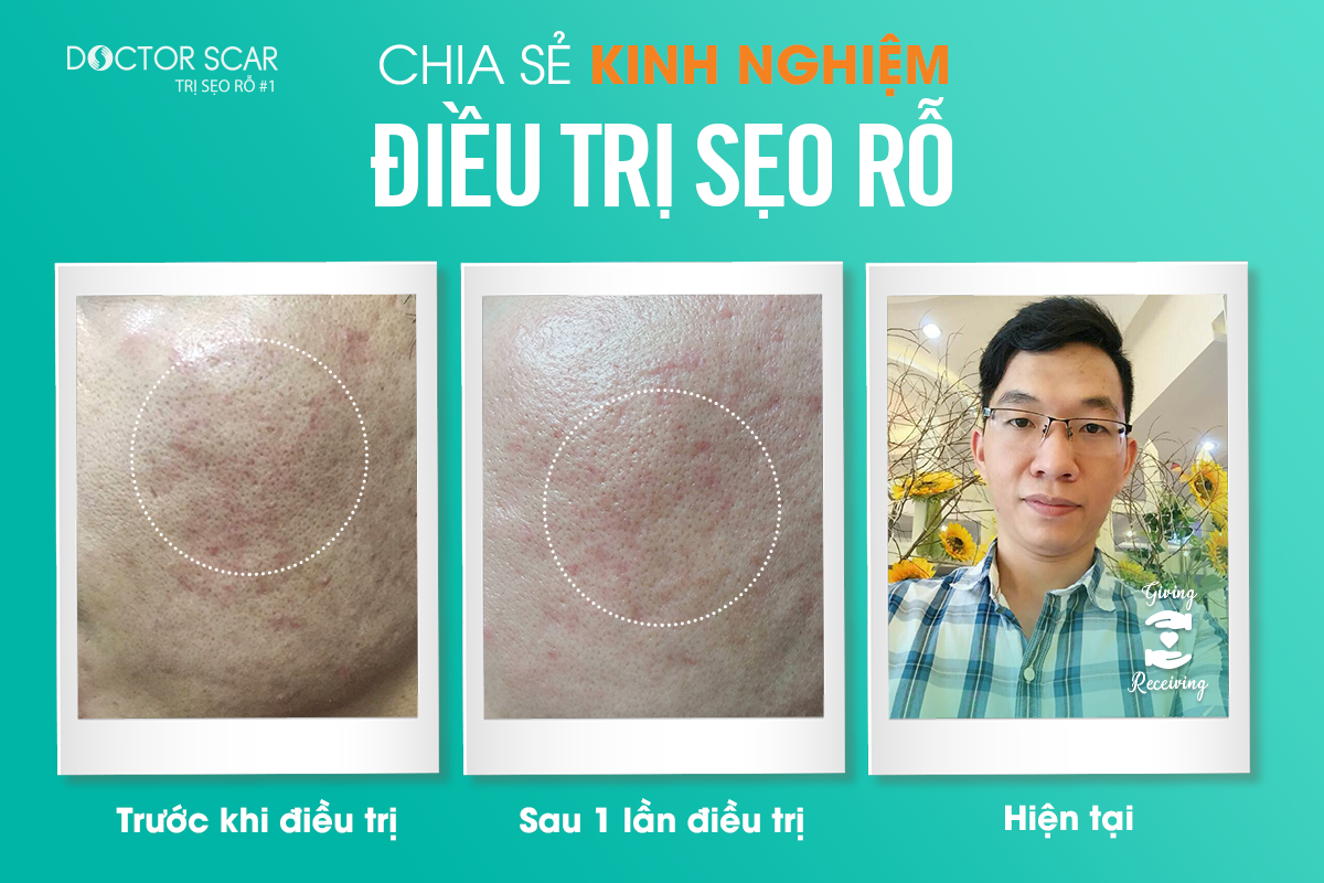 Chia-se-kinh-nghiem-dieu-tri-seo-ro -Le-Thanh-Binh