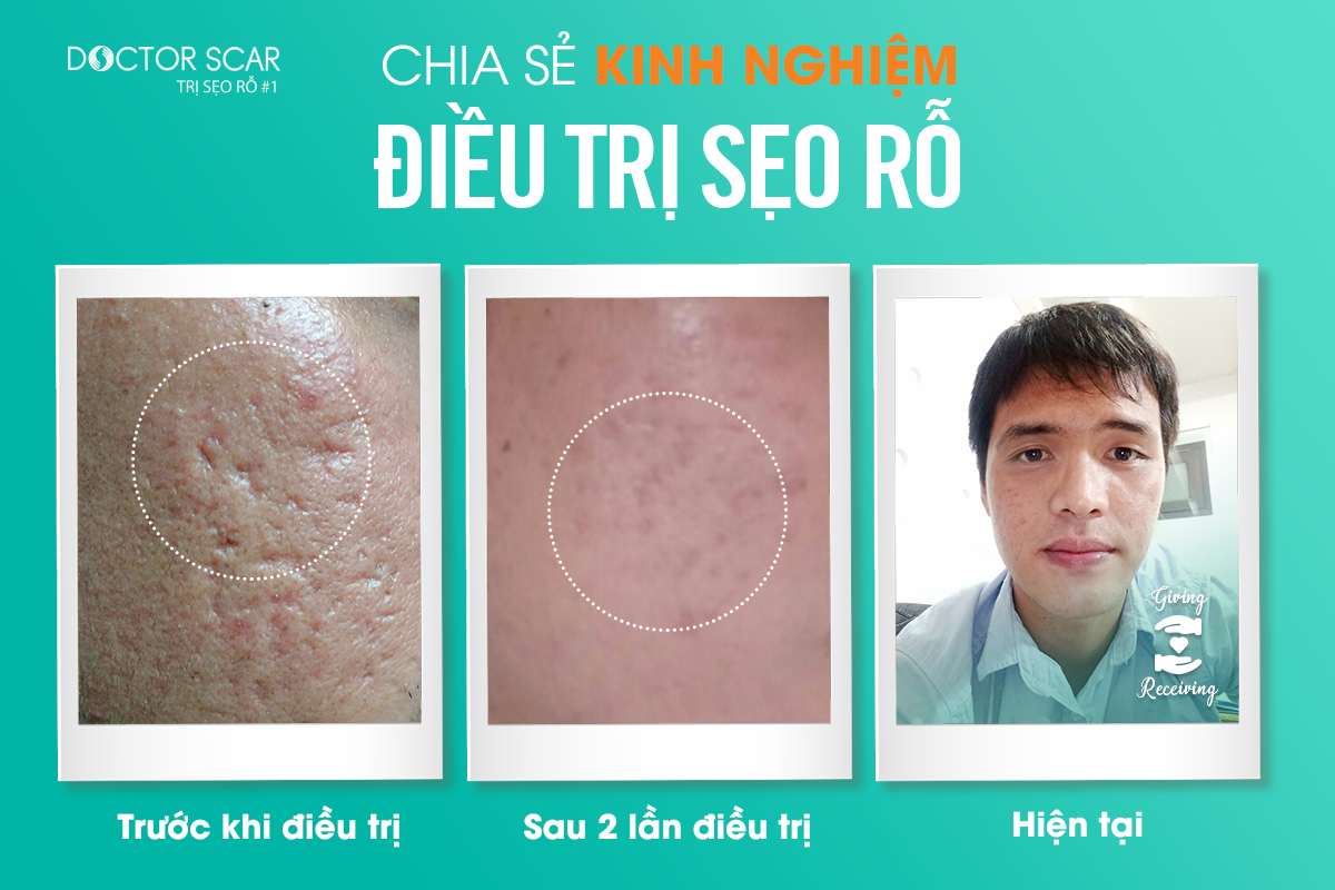 Chia-se-kinh-nghiem-dieu-tri-seo-ro -Nguyen-Tan-Huy