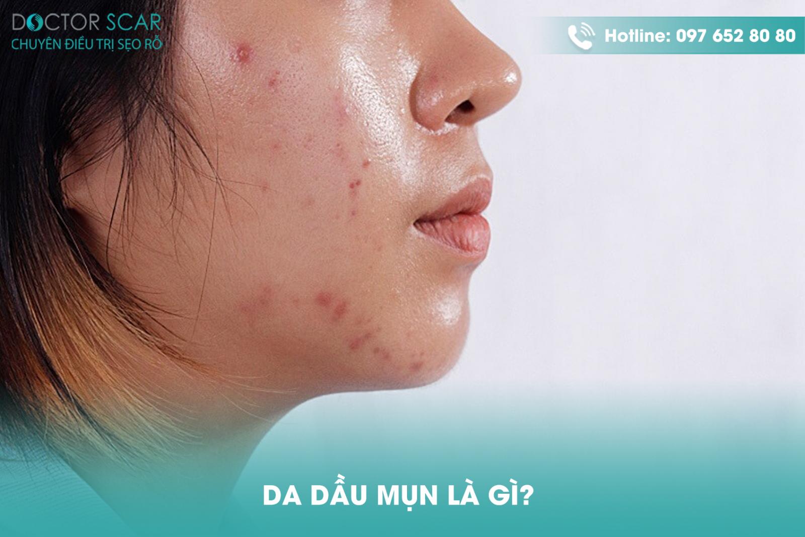 Da dầu mụn là gì?