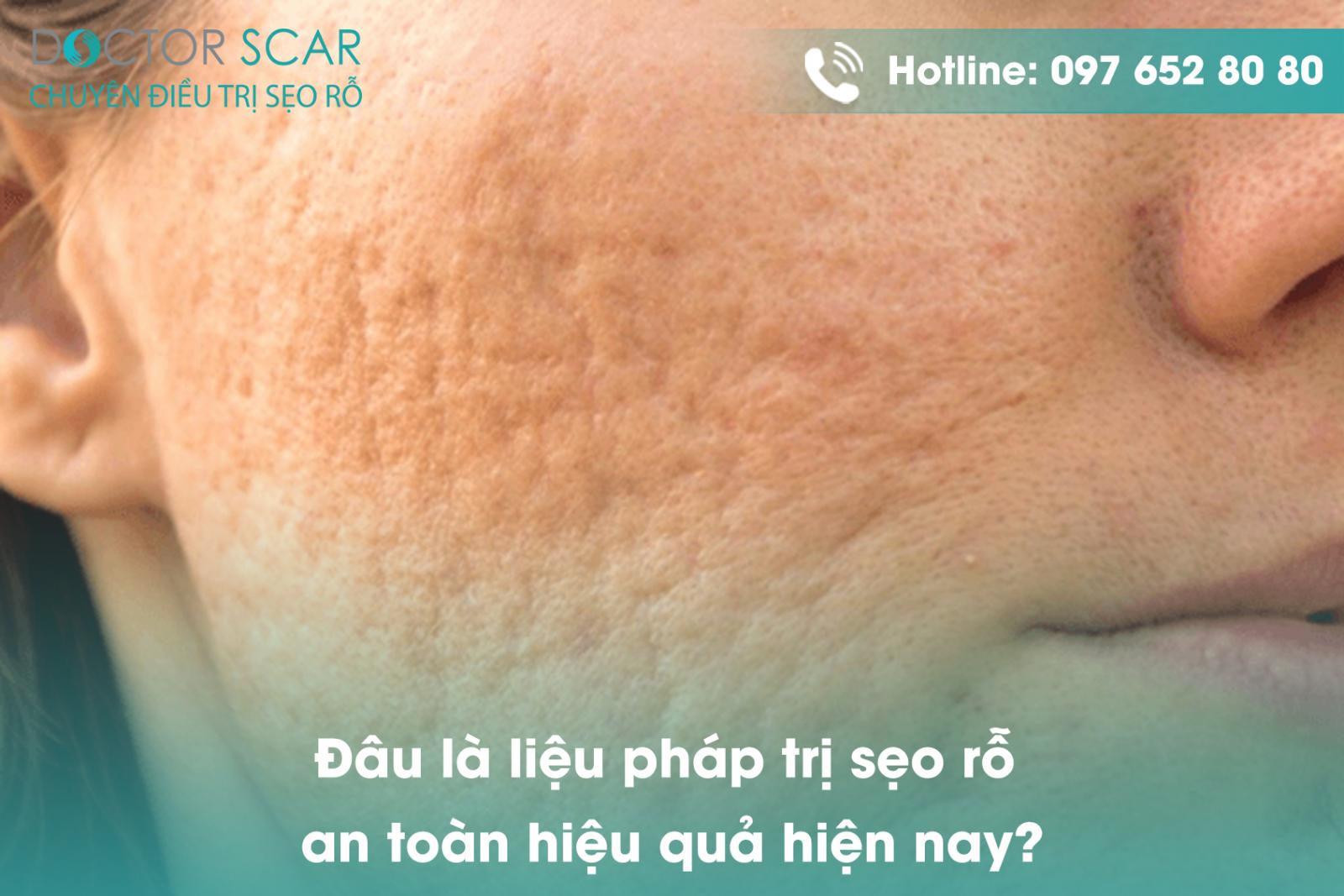 Đâu là liệu pháp trị sẹo rỗ an toàn hiệu quả hiện nay?