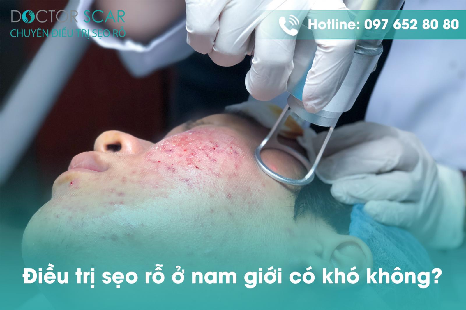 Điều trị sẹo rỗ ở nam giới có khó không?