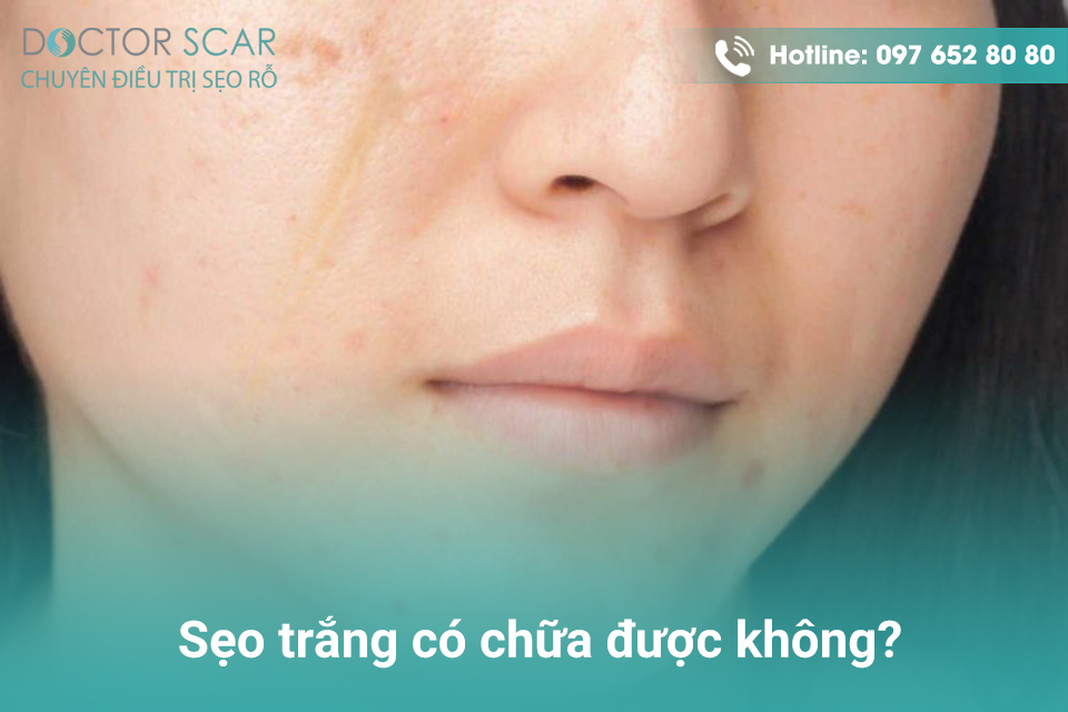 Sẹo trắng có chữa được không?