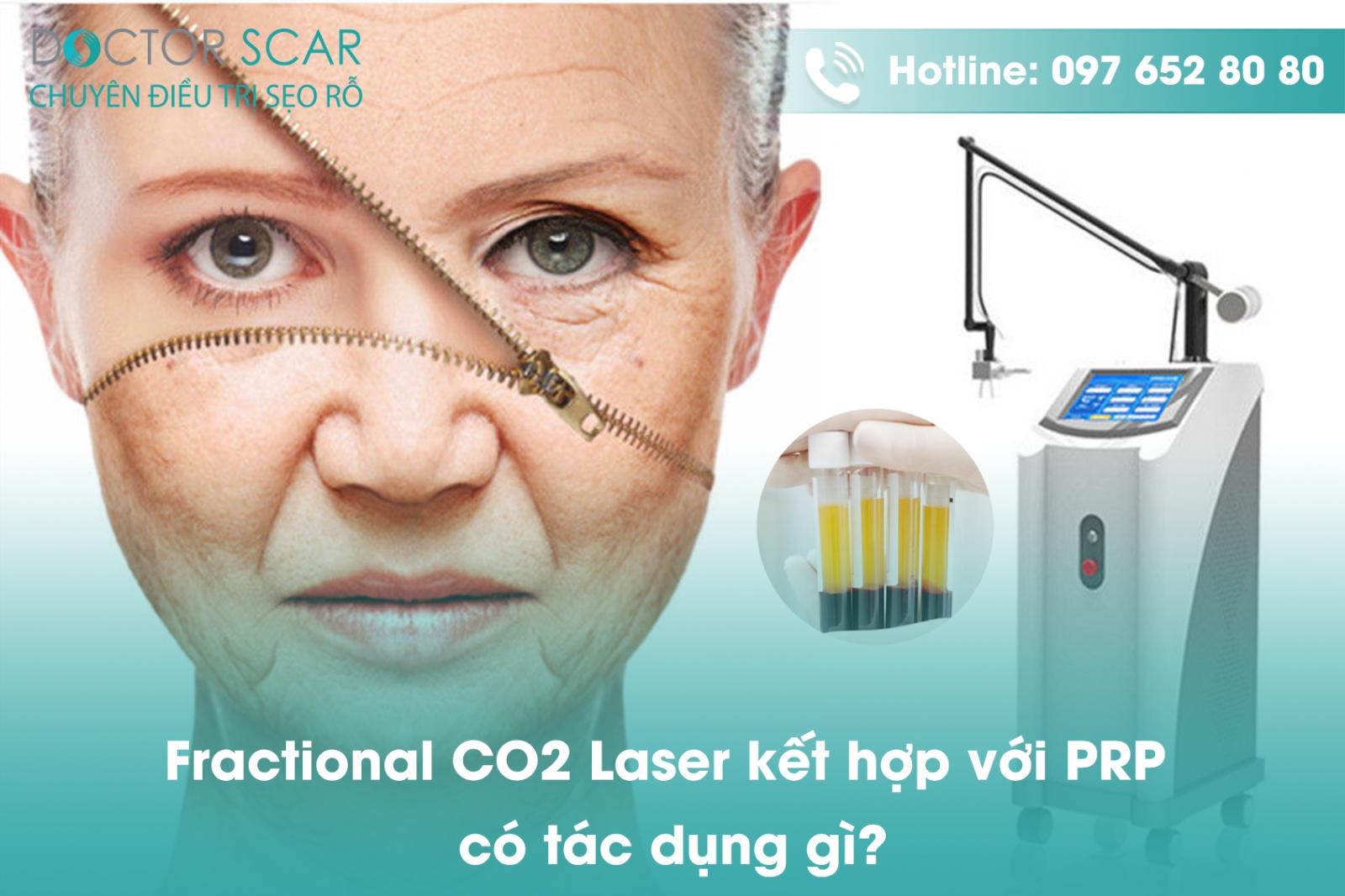 Fractional CO2 Laser kết hợp với PRP có tác dụng gì?