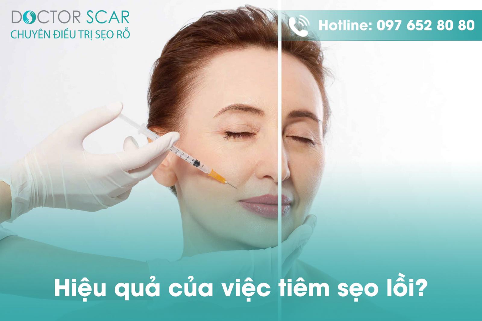 Hiệu quả của việc tiêm sẹo lồi?