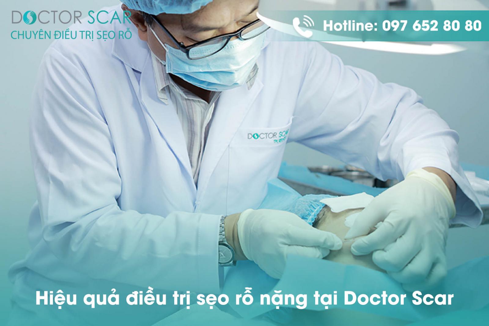 Hiệu quả điều trị sẹo rỗ nặng tại Doctor Scar