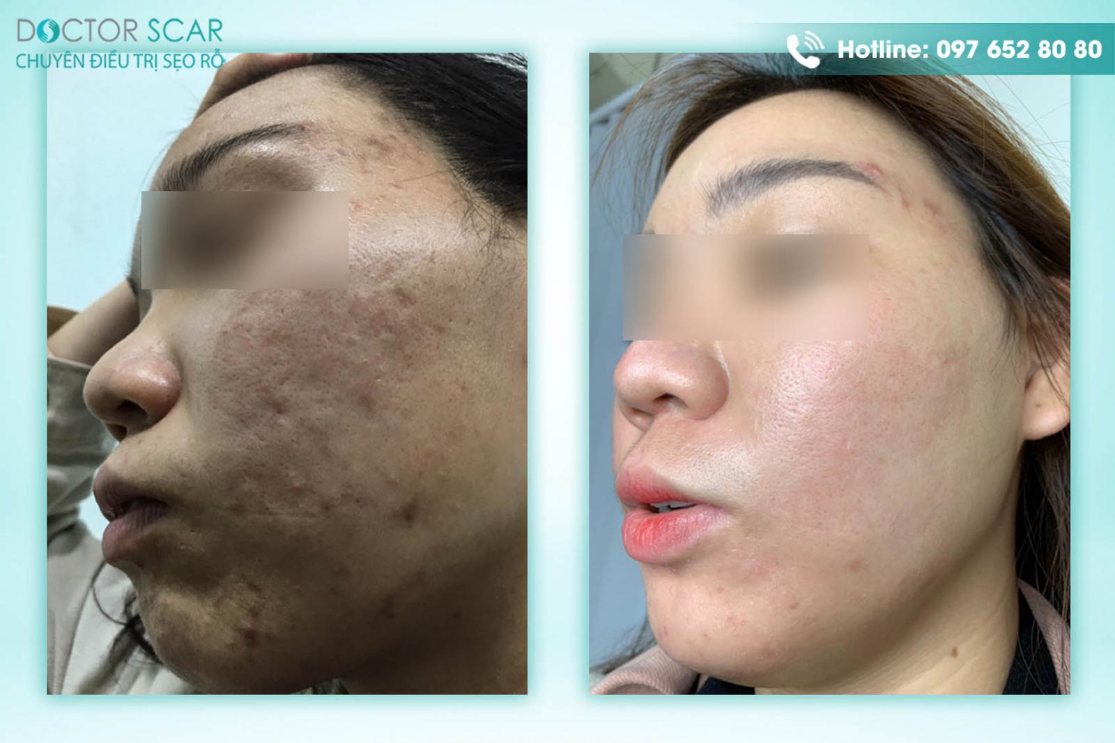 Khách hàng trước và sau điều trị da mặt bị sẹo rỗ tại Doctor Scar