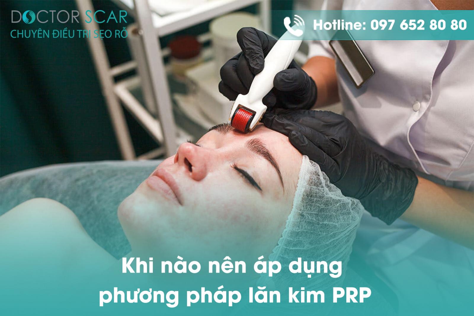 Khi nào nên áp dụng phương pháp lăn kim prp