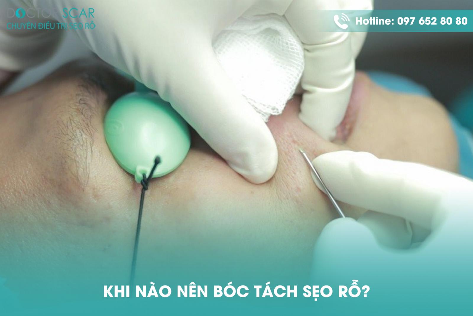 Khi nào nên bóc tách sẹo rỗ?