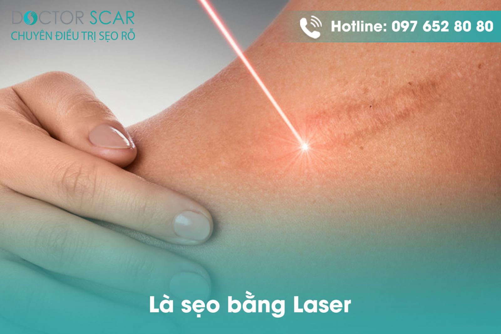 Là sẹo bằng Laser