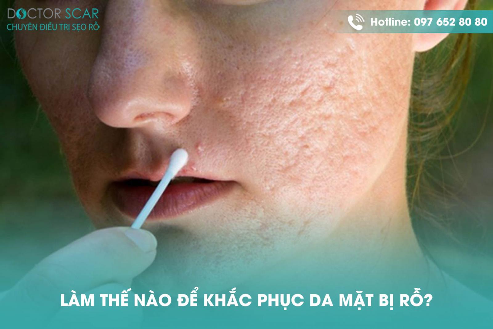 Làm thế nào để khắc phục da mặt bị rỗ?