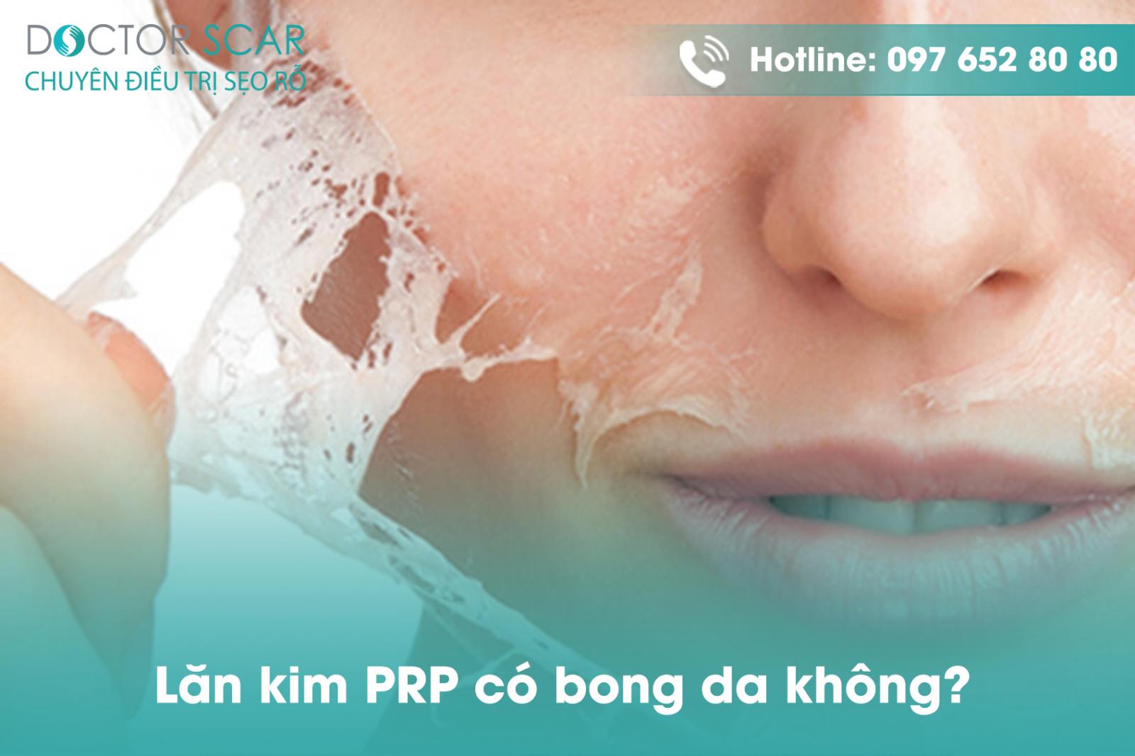 Lăn kim PRP có bong da không?