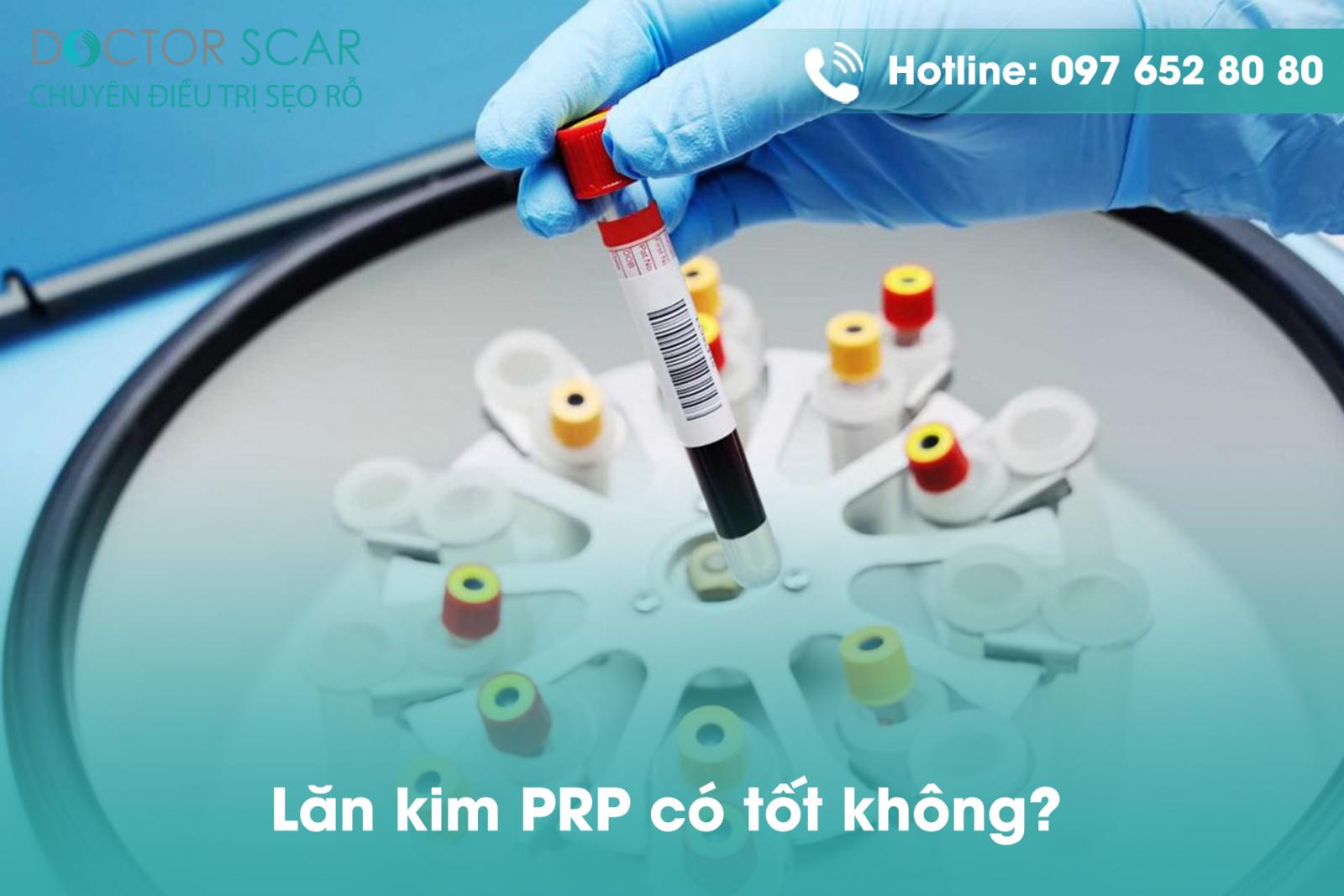 Lăn kim PRP có tốt không?