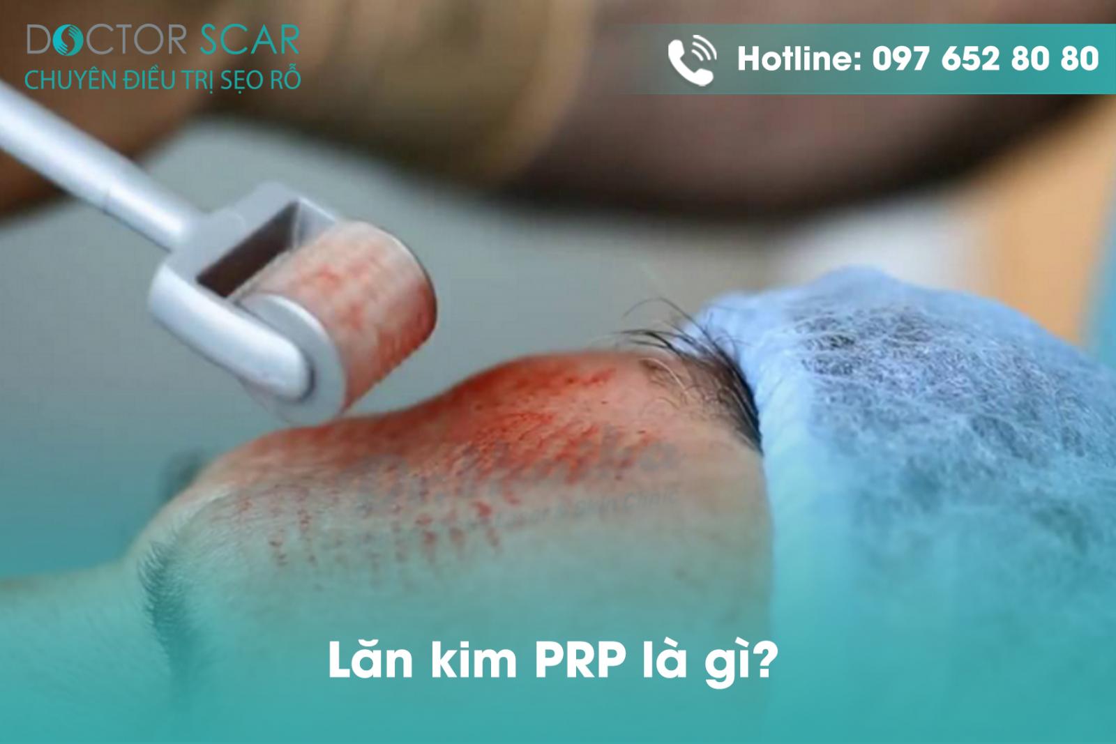 Lăn kim PRP là gì?