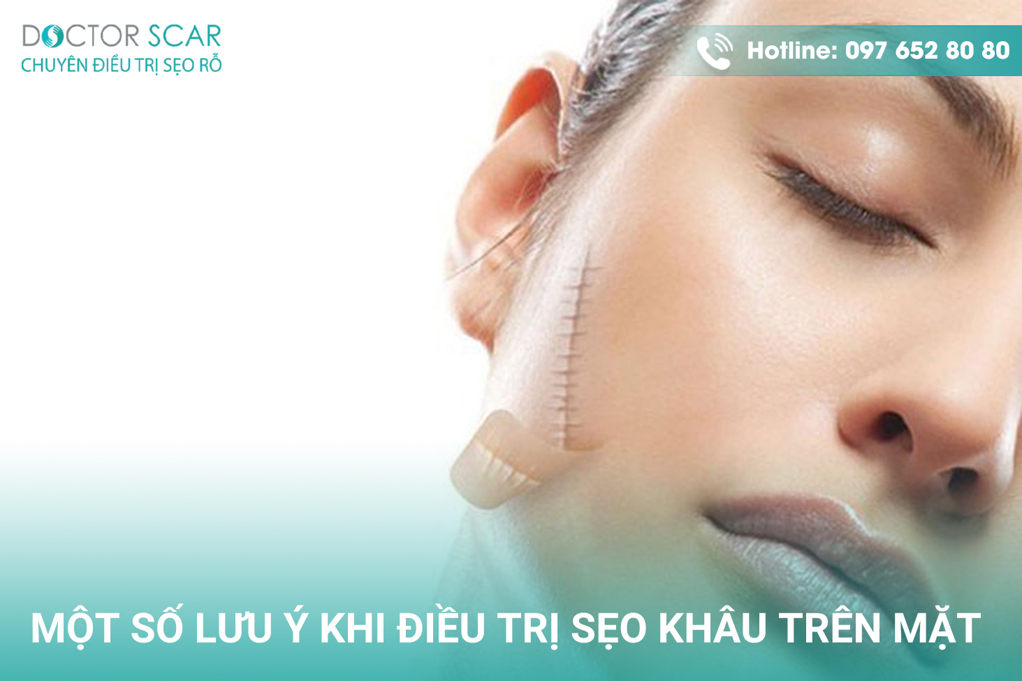 Một số lưu ý khi điều trị sẹo khâu trên mặt.