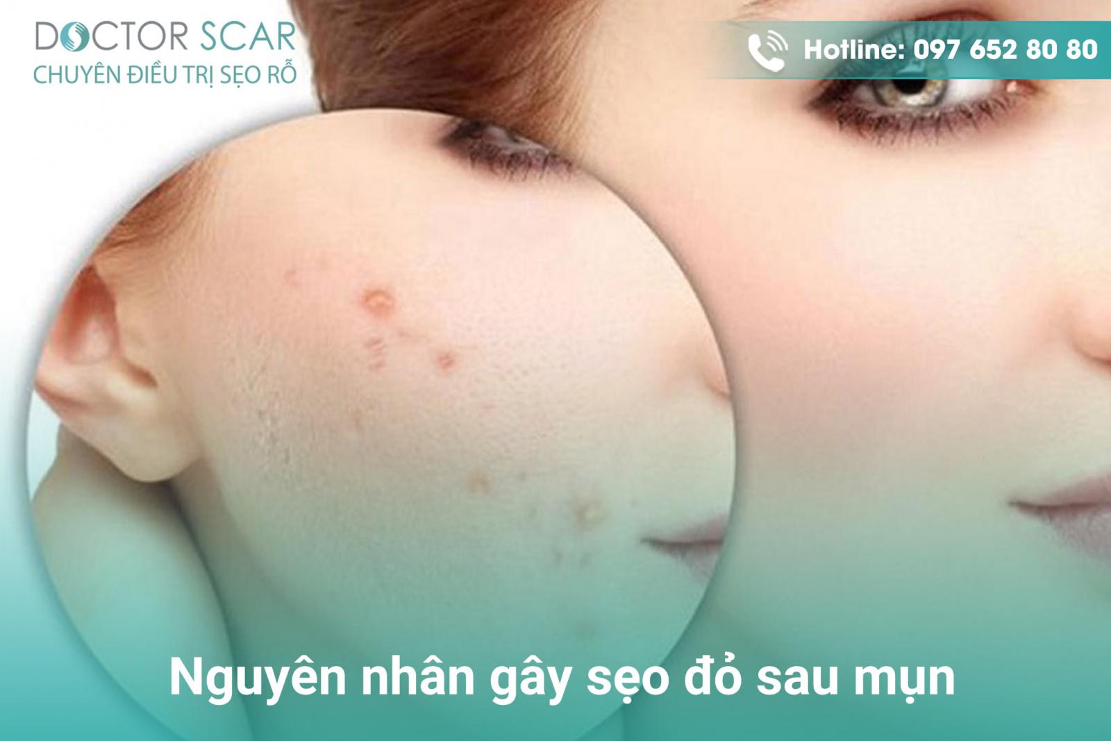 Nguyên nhân gây sẹo đỏ sau mụn.