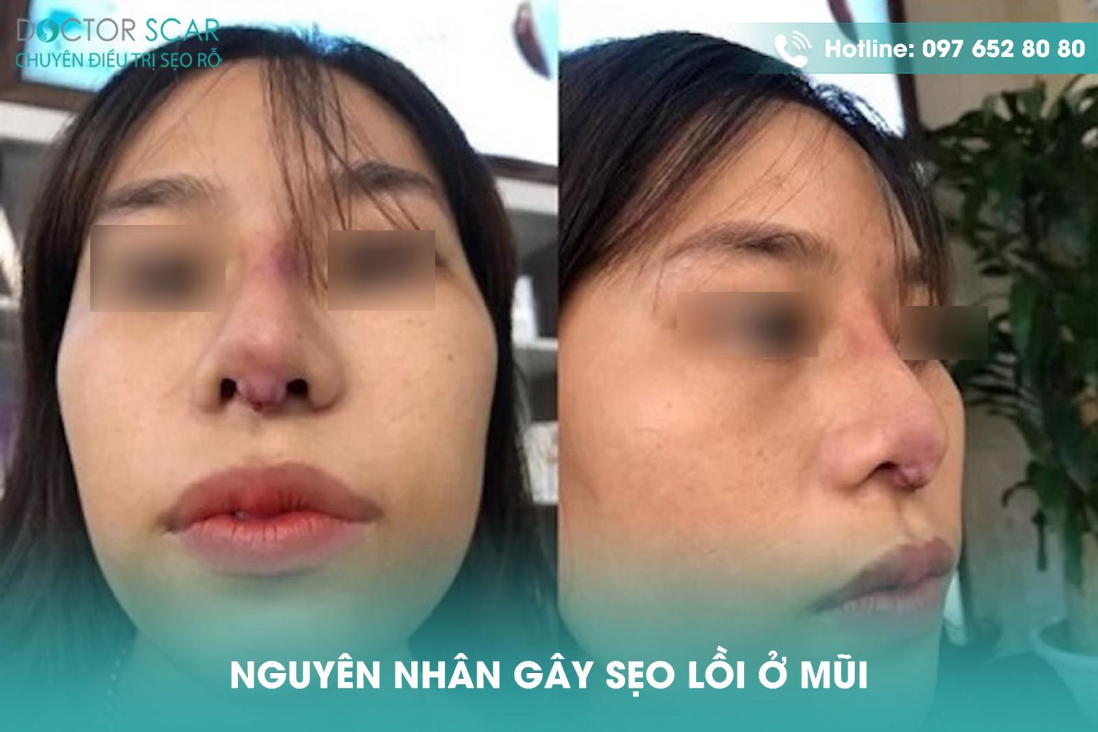 Nguyên nhân gây sẹo lồi ở mũi