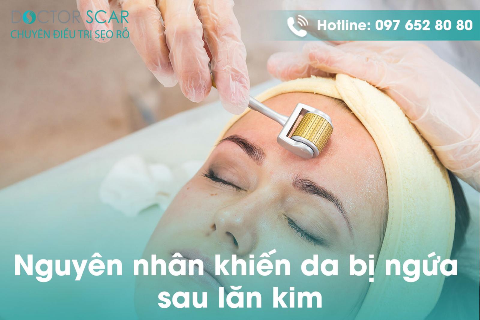 Nguyên nhân khiến da bị ngứa sau lăn kim