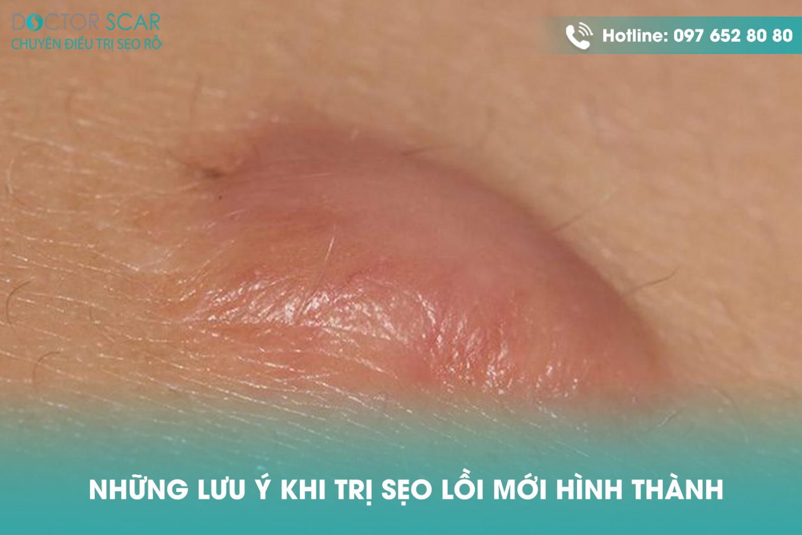 Những lưu ý khi trị sẹo lồi mới hình thành