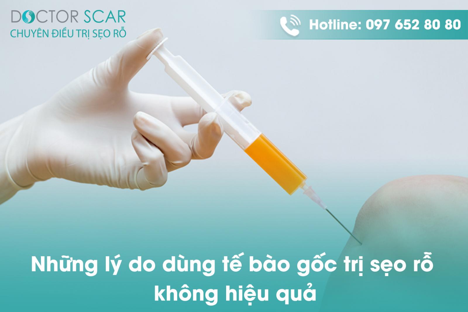 Những lý do dùng tế bào gốc trị sẹo rỗ không hiệu quả