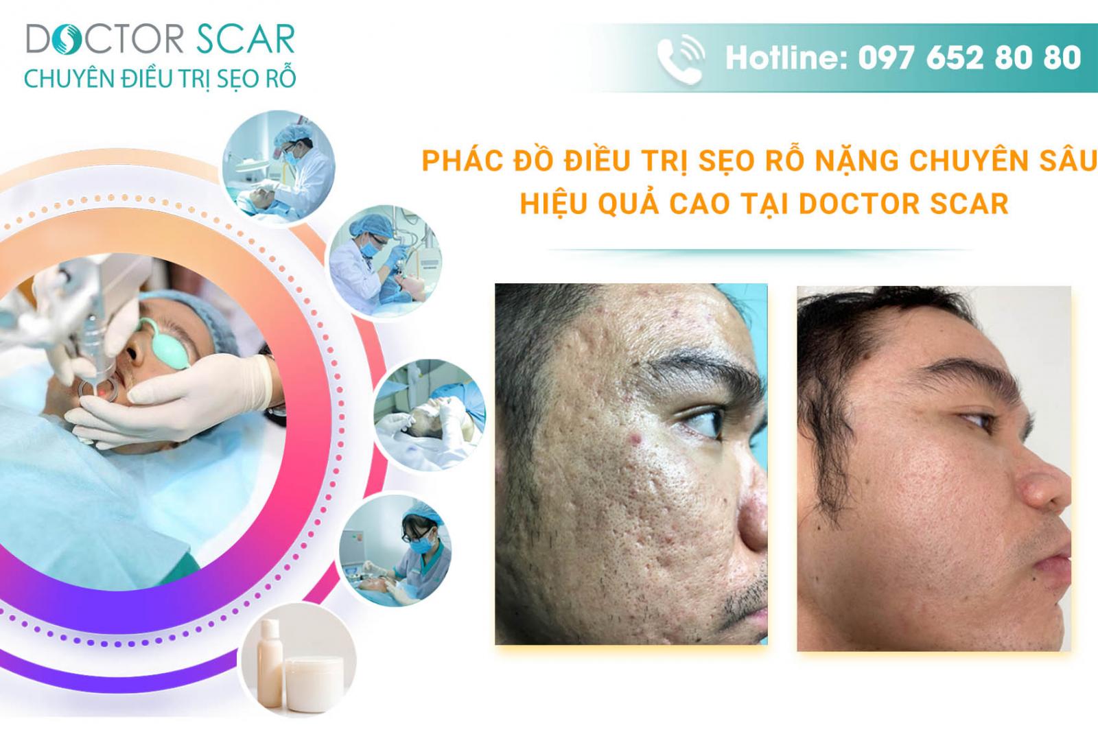 Phác đồ điều trị sẹo rỗ nặng chuyên sâu hiệu quả cao tại Doctor Scar